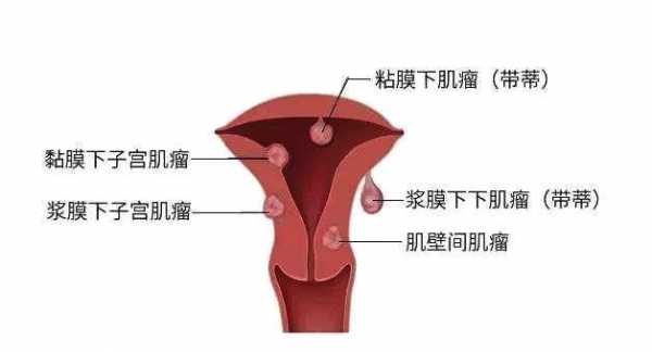 消除子宫肌瘤念什么咒（子宫瘤肌瘤怎么念佛能没）-图3